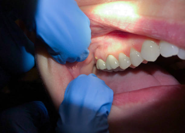 Best Emergency Treatment for Oral Infections in West Baraboo, WI